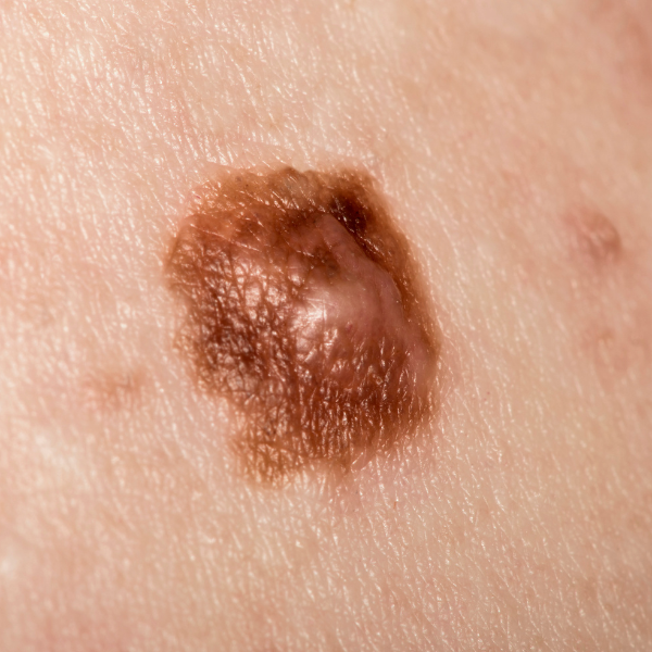 skin biopsy