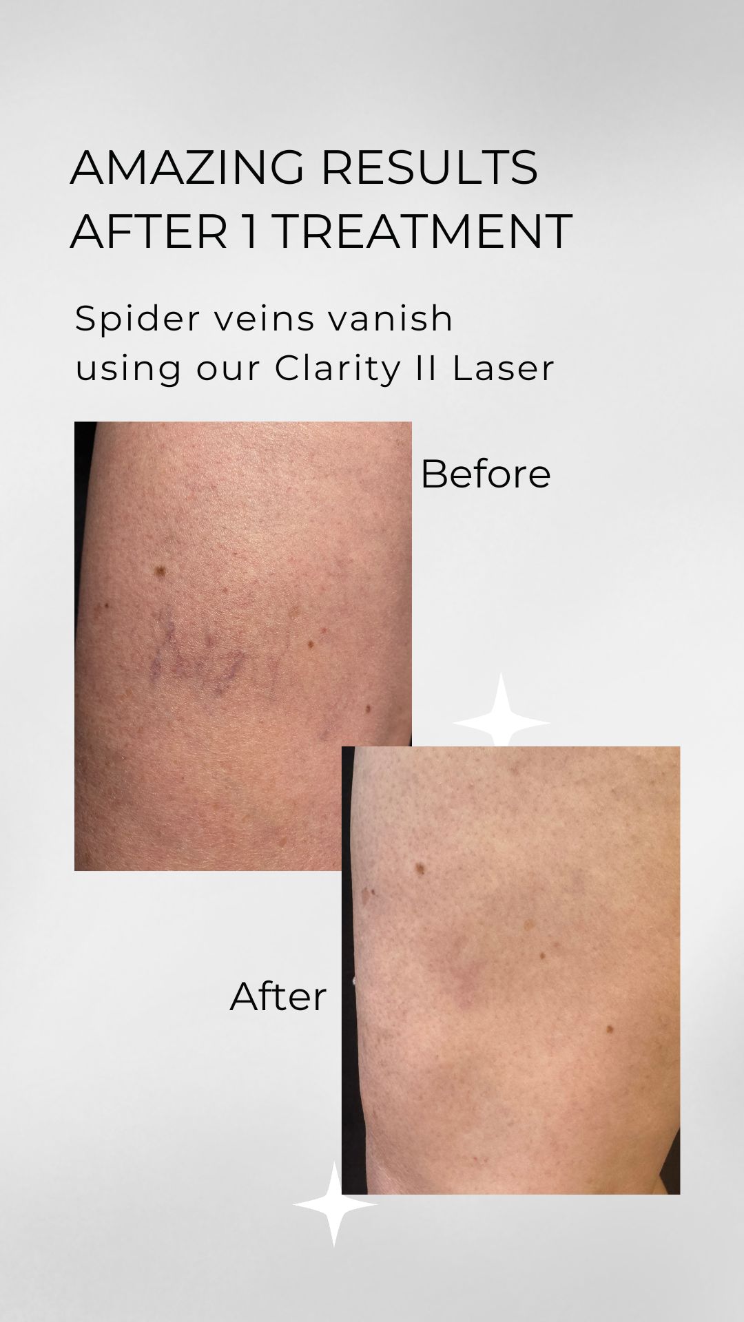 Laser Vein Treatment