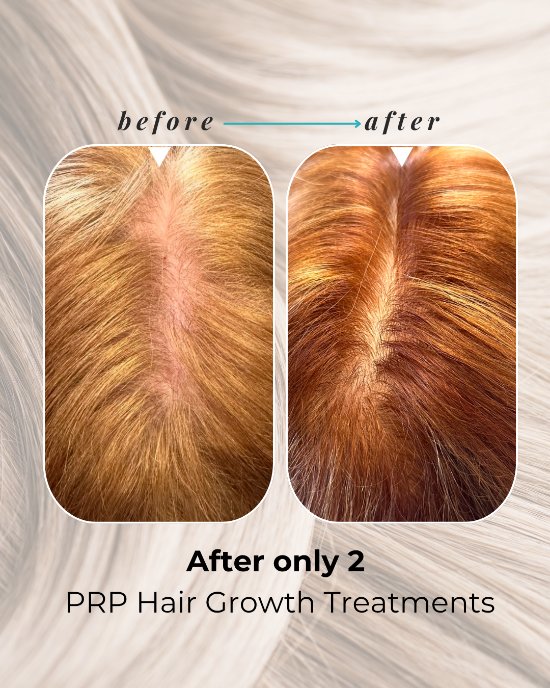 Results from PRP Hair Treatment Results from PRP Hair Treatment