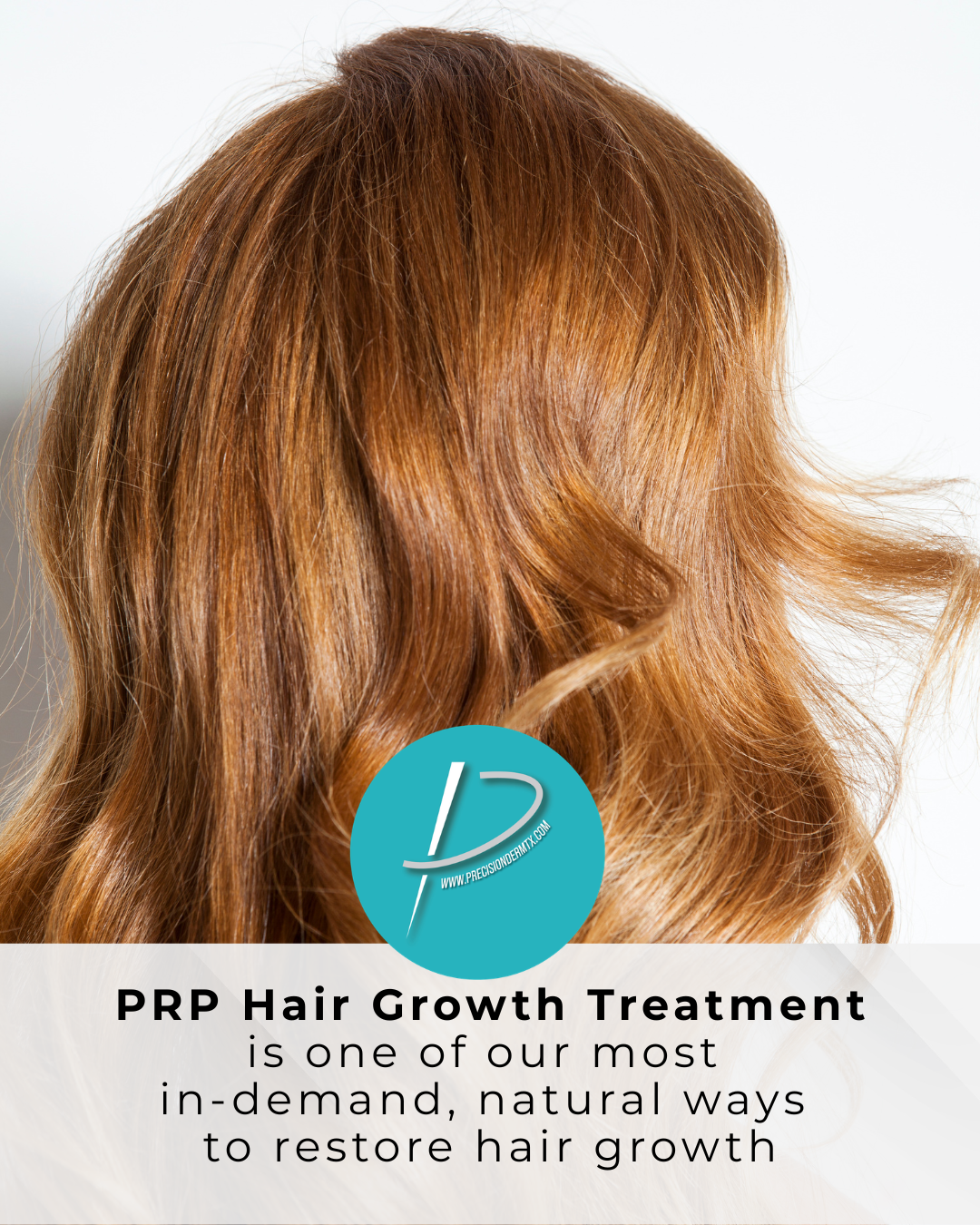 PRP for Hair Loss