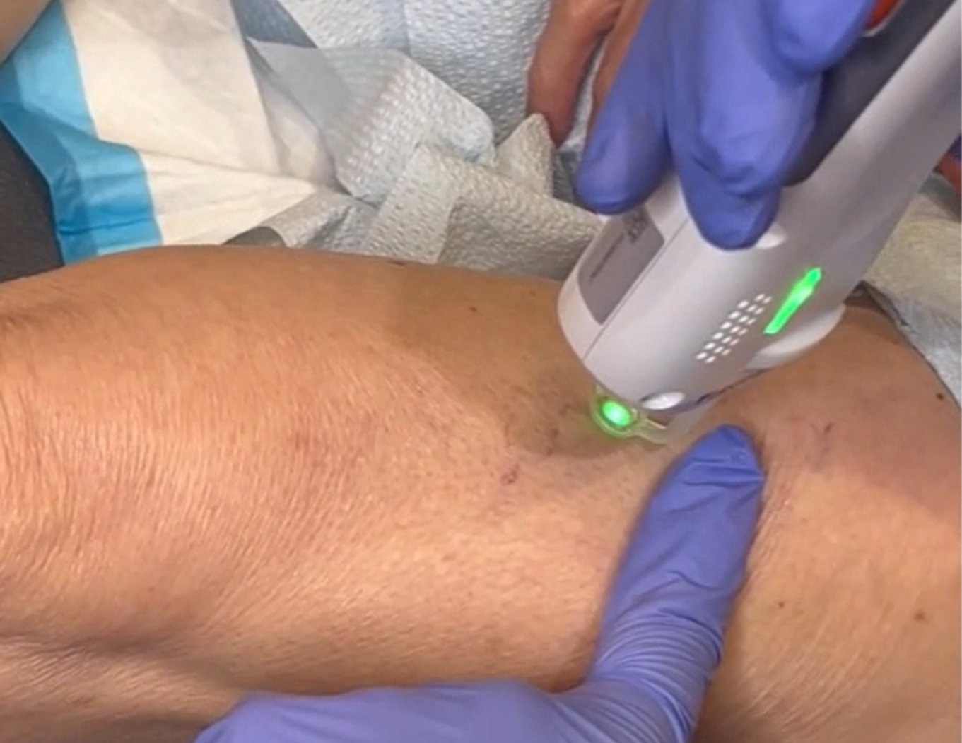 Clarity II™ Laser Vein Treatment