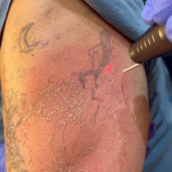 Tattoo Removal Treatment