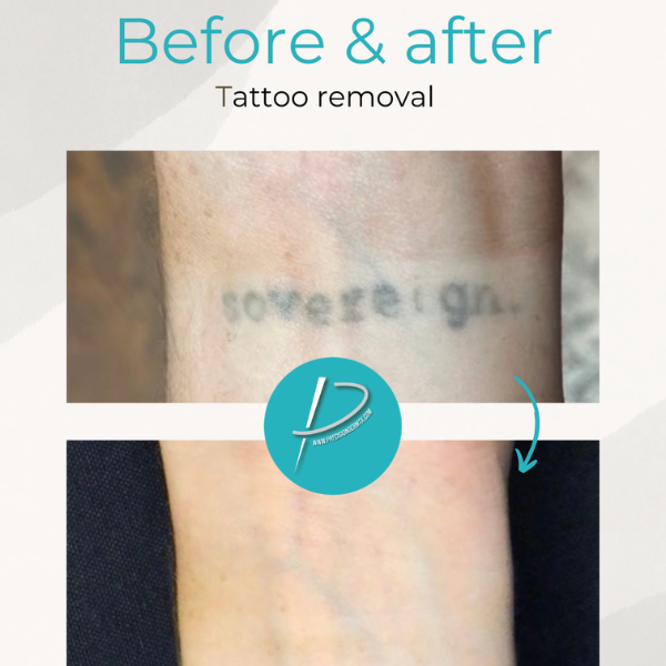 before and after tattoo removal